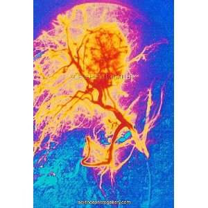  Coloured angiogram X ray of a tumour in the liver Framed 