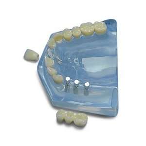   Upper Arch  Central & 3 unit bridge implant supported 
